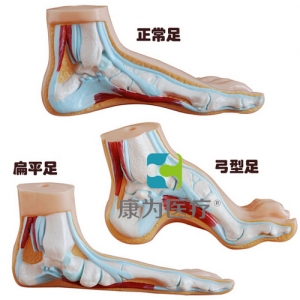 “康為醫(yī)療”正常足、扁平足、弓型足模型