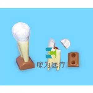 “康為醫(yī)療”上頜兩根齲齒模型(2部分，放大)