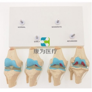 “康為醫(yī)療”四階段病變膝關節(jié)模型，4階段膝關節(jié)模型