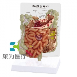 “康為醫(yī)療”醫(yī)患關系溝通模型-病理大、小腸模型（醫(yī)學指導模型）