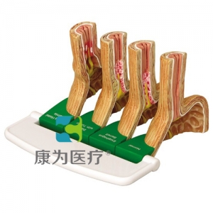 “康為醫(yī)療”醫(yī)患關系溝通模型-胃食管反流?。℅ERD）模型 （醫(yī)學指導模型）